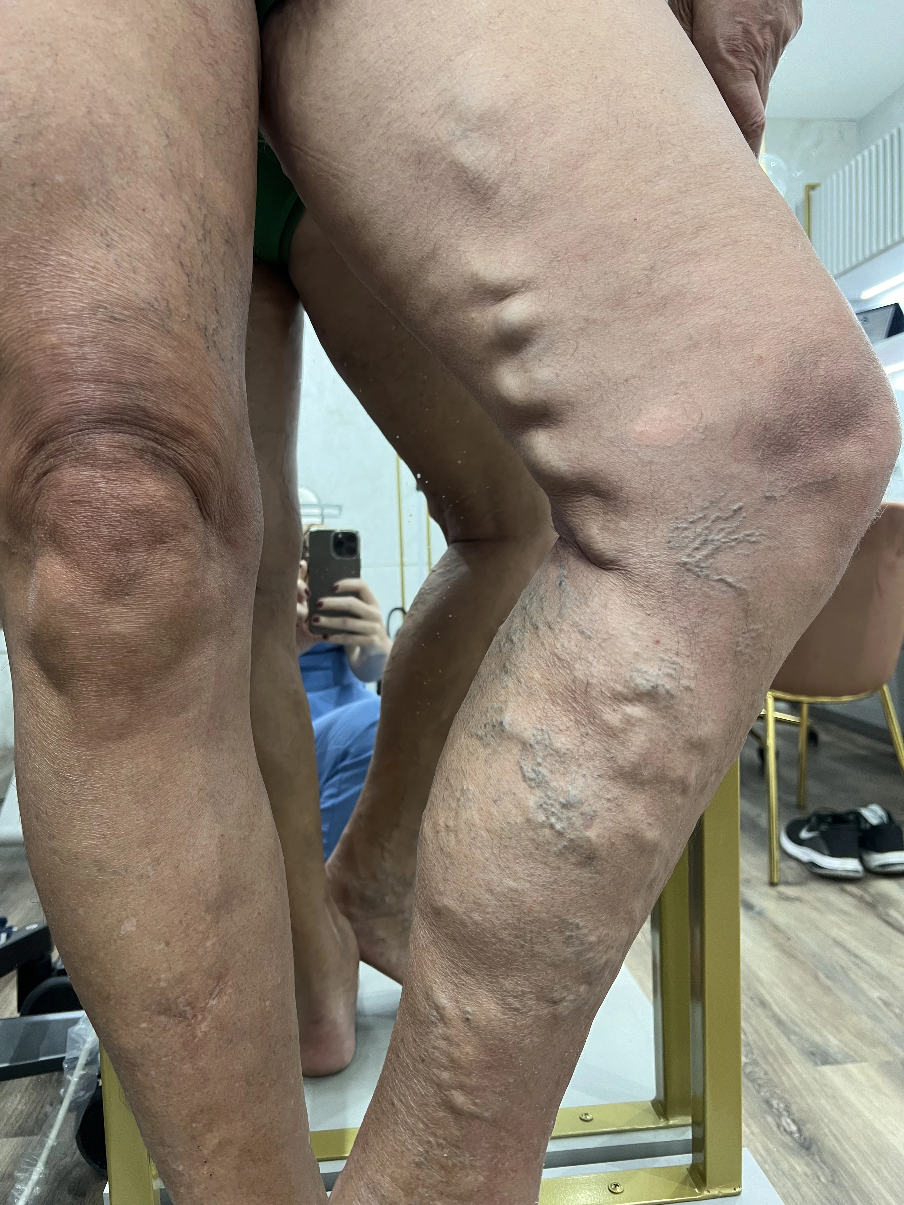 Pernas com varizes antes do tratamento Endolaser